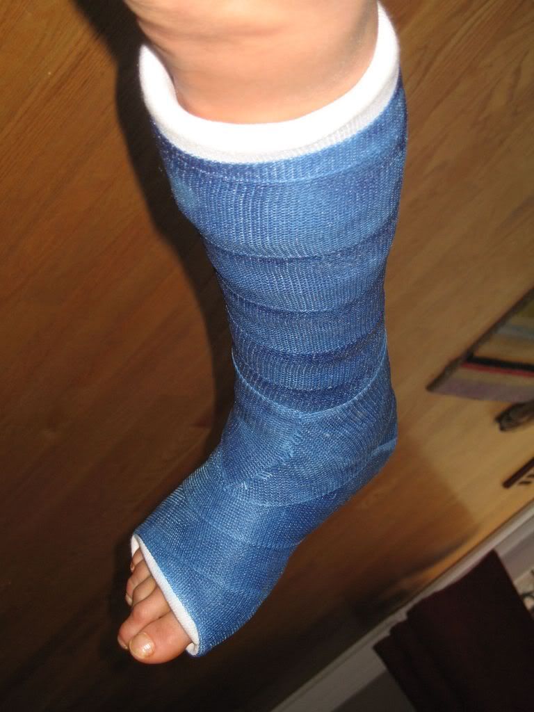 The Fiberglass Cast May 14, 2008 Photo by liamsmom_27 Photobucket