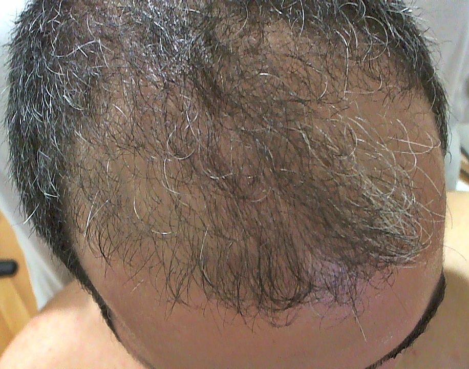  Antalya'da en iyi 'Saç Ekim Merkezi' hakkında bilgisi olan?