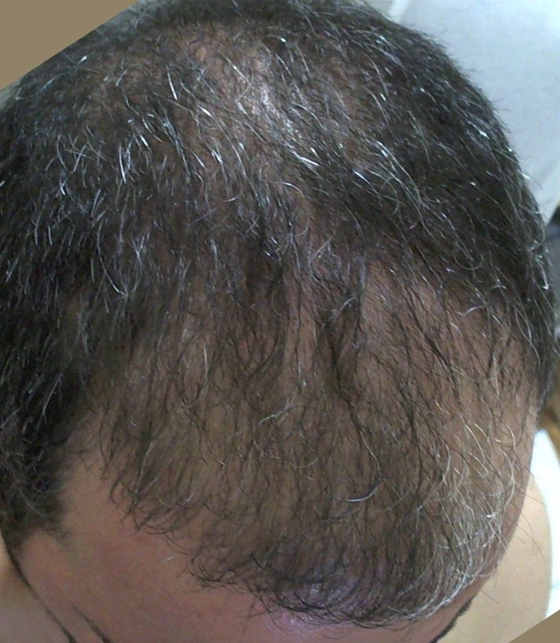  Antalya'da en iyi 'Saç Ekim Merkezi' hakkında bilgisi olan?