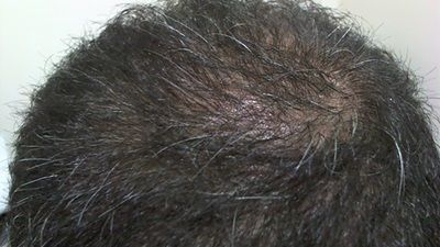  Antalya'da en iyi 'Saç Ekim Merkezi' hakkında bilgisi olan?